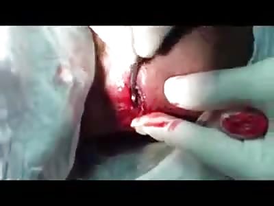 Scalp ulcer full of maggots.