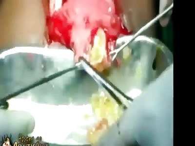 Two gallon cyst drainage.