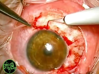 Intraocular Tumor Surgery