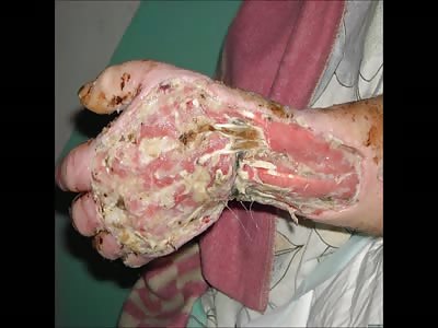 Krokodil (Desomorphine) consecuences
