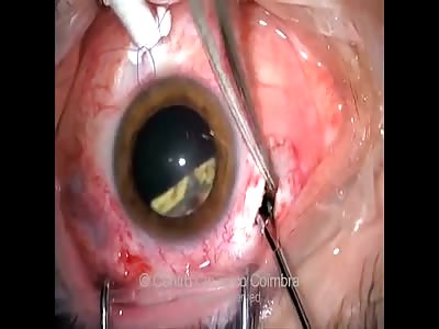 SHARD OF GLASS REMOVED FROM EYEBALL (ORIGINAL VIDEO)