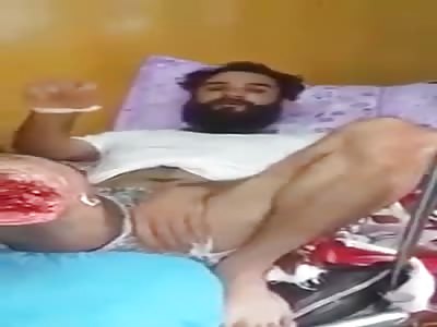 MUJAHIDEEN LOST LEG IN BATTLE