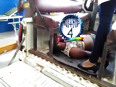 LOOK AT THIS GUY: HE HAD BOTH FEET TORN APART IN A MACHINE