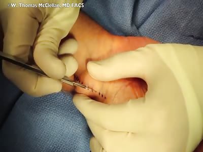 ganglion cyst operation