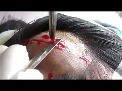 Large Scalp Cyst!