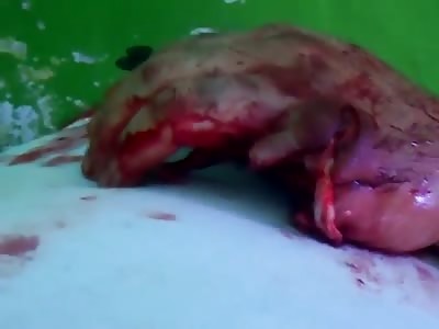 Injured Hand By a Bomb 